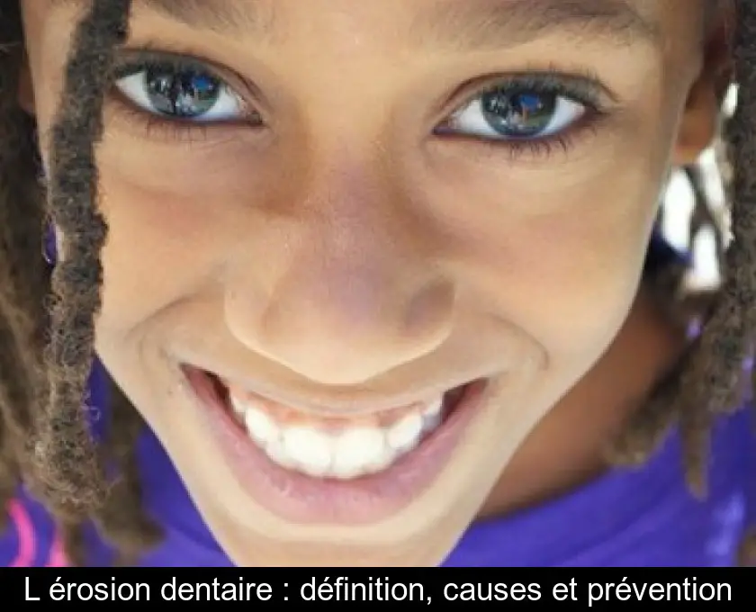 L'érosion dentaire : définition, causes et prévention