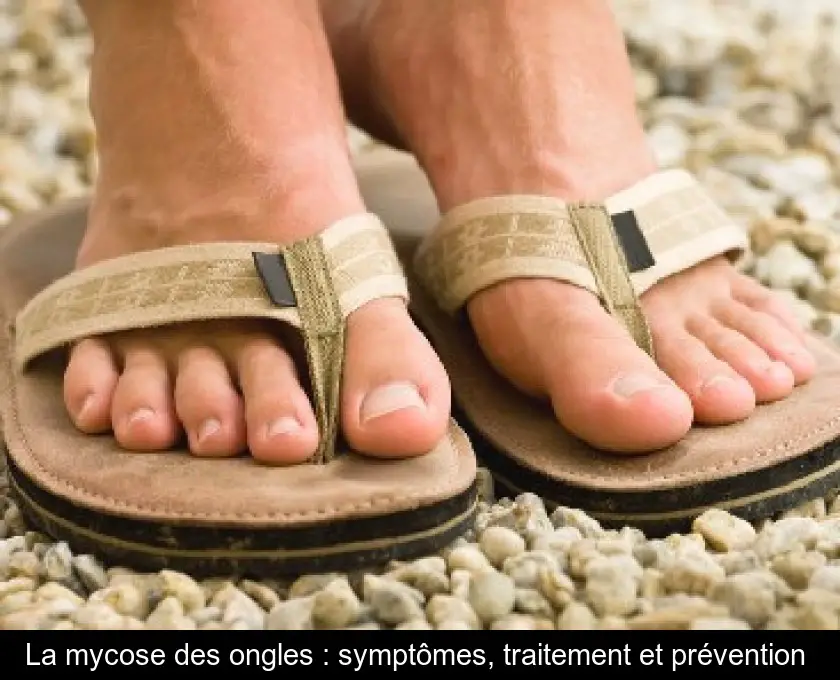 La mycose des ongles : symptômes, traitement et prévention 