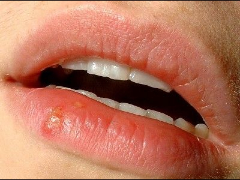 comment traiter herpes buccal
