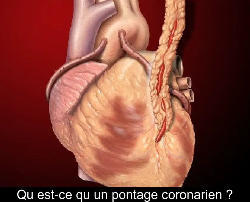 Qu'est-ce qu'un pontage coronarien ?