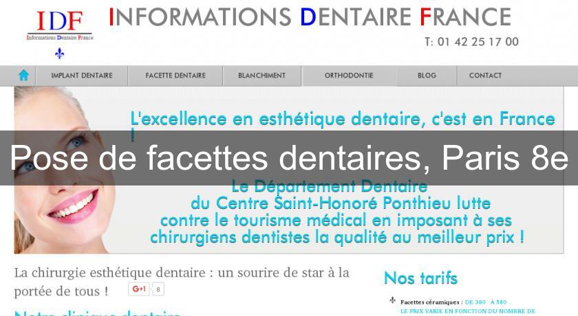 Pose de facettes dentaires, Paris 8e Pose de facettes dentaires, Paris 8e