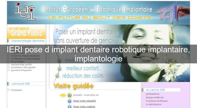 IERI pose d'implant dentaire robotique implantaire, implantologie IERI pose d'implant dentaire robotique implantaire, implantologie