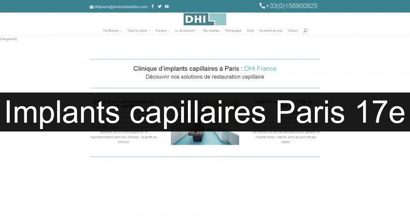 Implants capillaires Paris 17e Implants capillaires Paris 17e