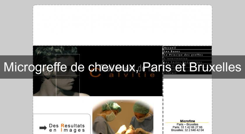 Microgreffe de cheveux, Paris et Bruxelles Microgreffe de cheveux, Paris et Bruxelles