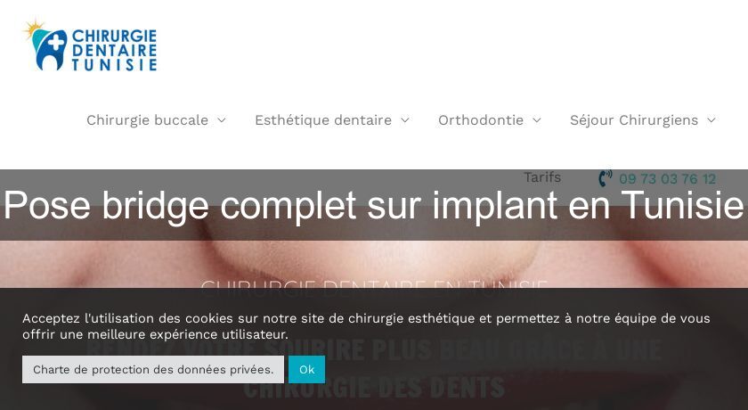 Pose bridge complet sur implant en Tunisie Pose bridge complet sur implant en Tunisie