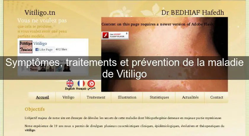 Symptômes, traitements et prévention de la maladie de Vitiligo