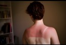 Réparer un coup de soleil : conseils et astuces