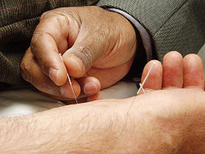 Acupuncture Acupuncture