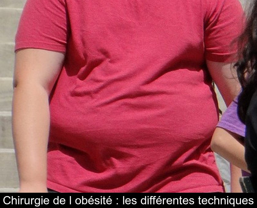 Chirurgie de l'obésité : les différentes techniques Chirurgie de l'obésité : les différentes techniques