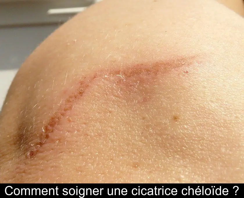 https://www.gralon.net/articles/vignettes/thumb-comment-soigner-une-cicatrice-cheloide--12271.jpg