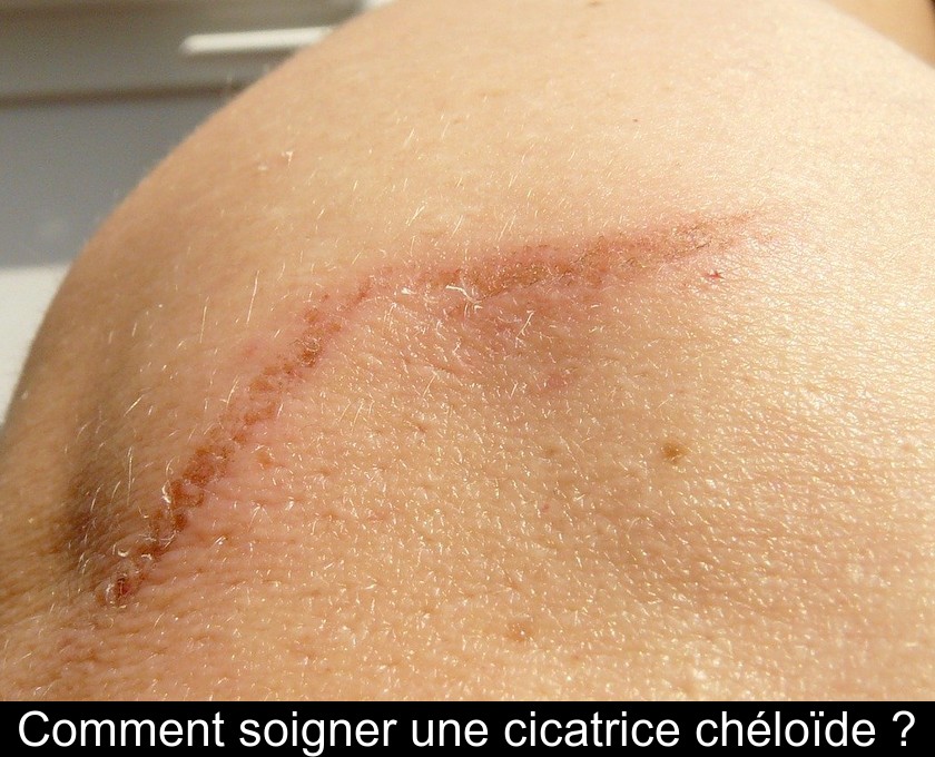 Cicatrice cheloide : quelles solutions pour la faire disparaitre ?