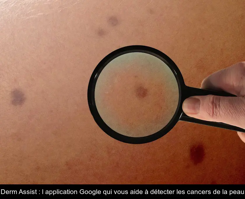 Derm Assist : l'application Google qui vous aide à détecter les cancers de la peau