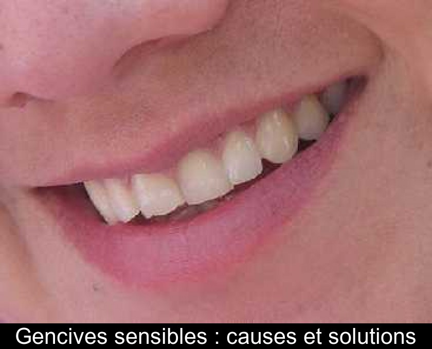 Gencives sensibles : causes et solutions