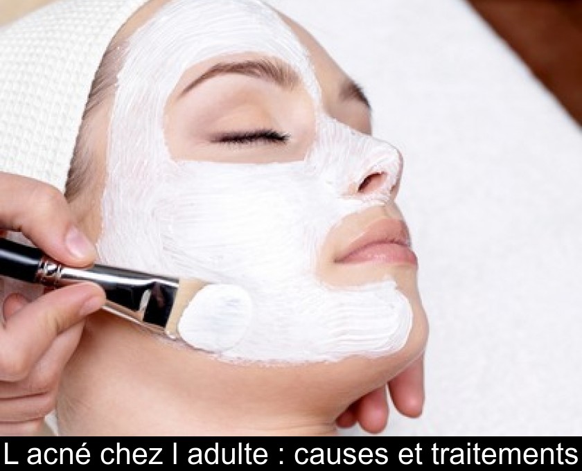 L'acné chez l'adulte : causes et traitements L'acné chez l'adulte : causes et traitements