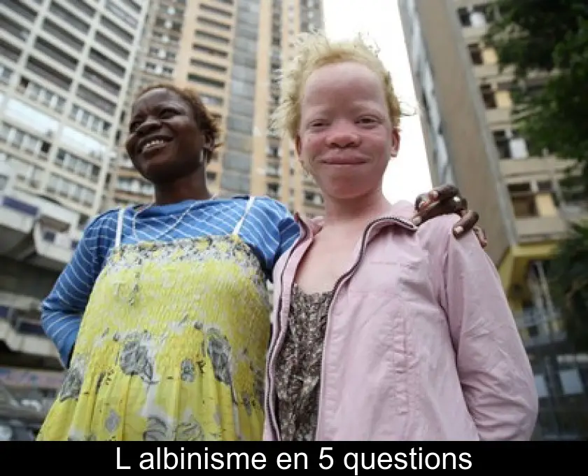 L'albinisme en 5 questions