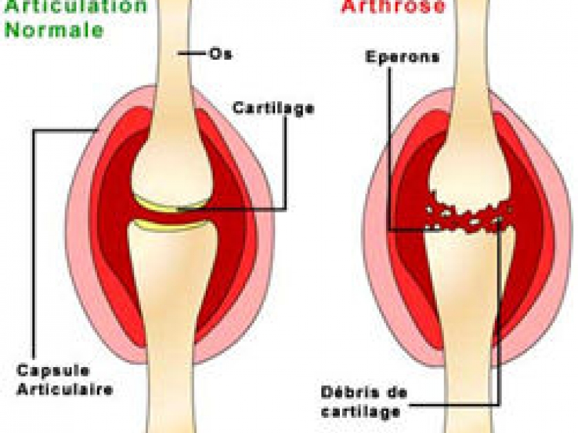 L'Arthrose L'Arthrose