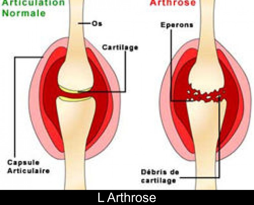 L'Arthrose L'Arthrose