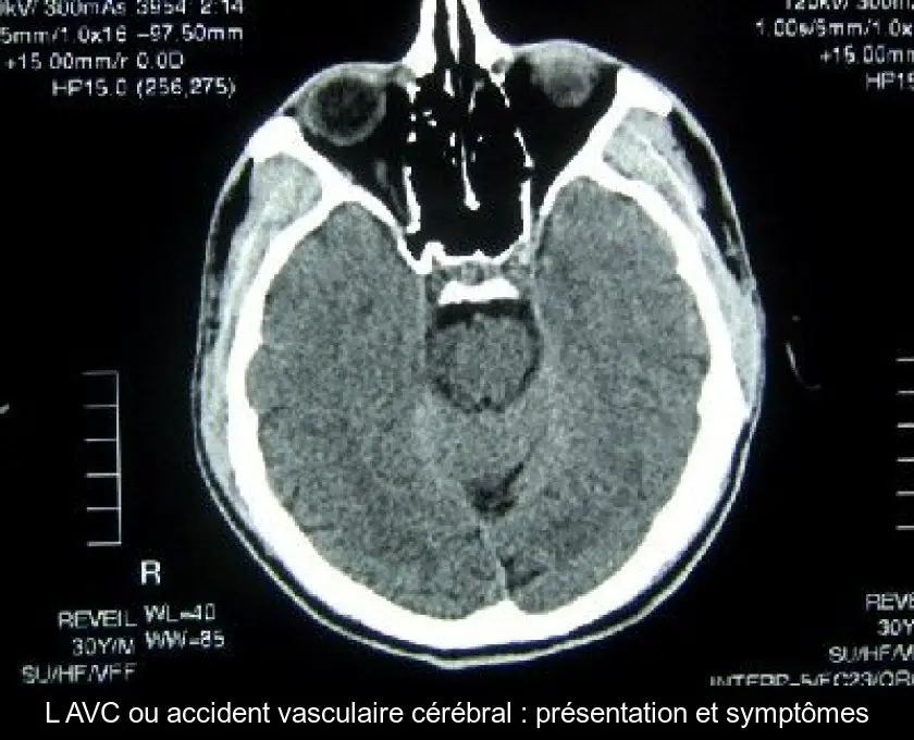 L'AVC ou accident vasculaire cérébral : présentation et symptômes
