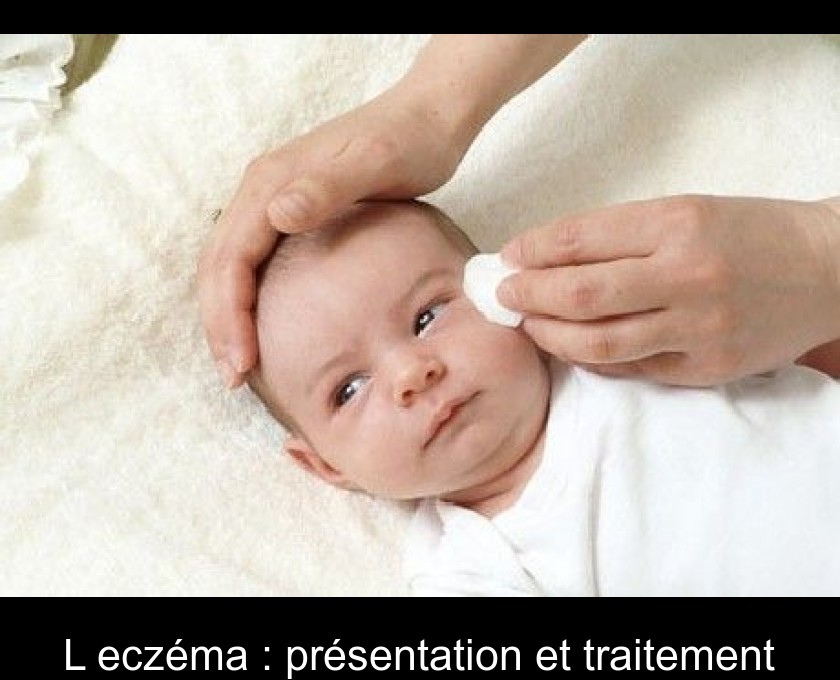 L'eczéma : présentation et traitement