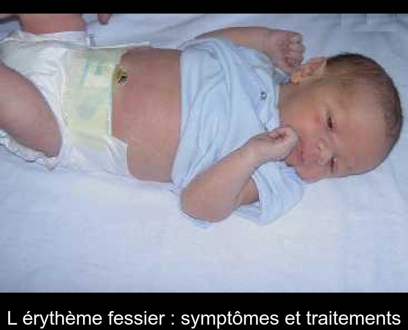 L Erytheme Fessier Symptomes Et Traitements L Erytheme Fessier Symptomes Et Traitements