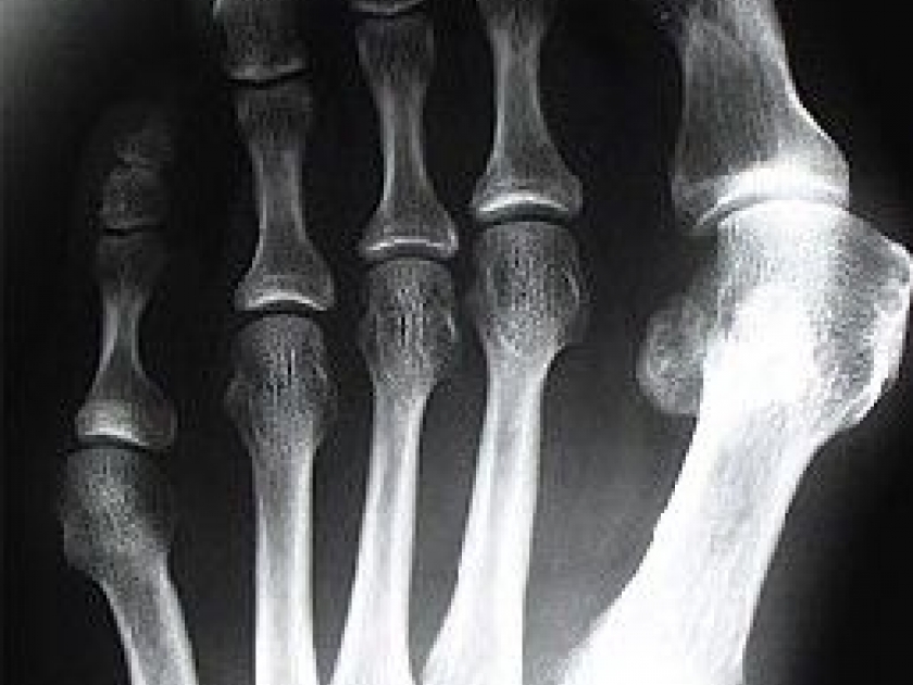 L'hallux valgus : présentation et traitement L'hallux valgus : présentation et traitement