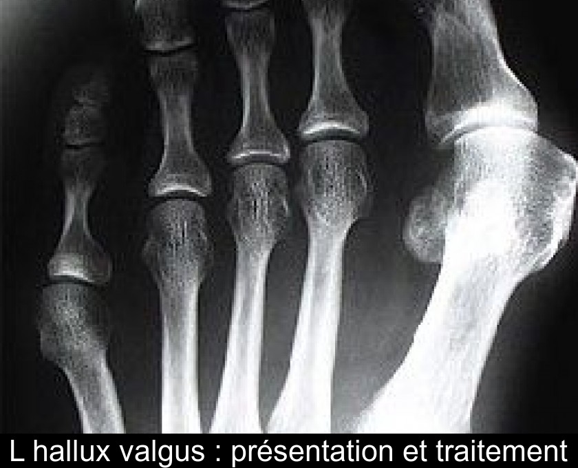 L'hallux valgus : présentation et traitement