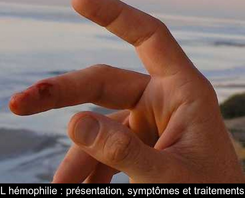 L'hémophilie : présentation, symptômes et traitements L'hémophilie : présentation, symptômes et traitements