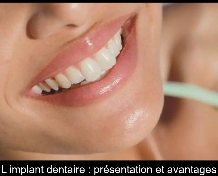 L'implant dentaire : présentation et avantages