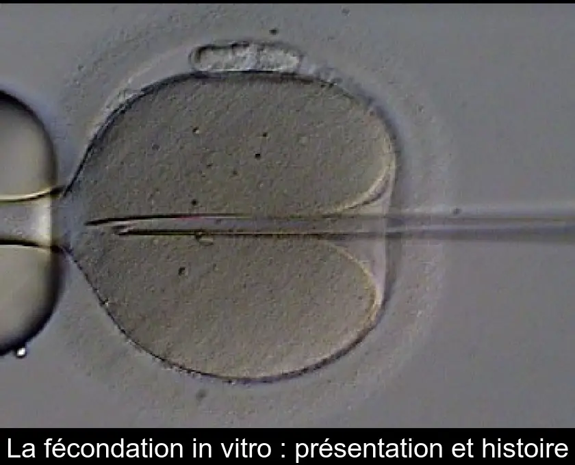La fécondation in vitro : présentation et histoire