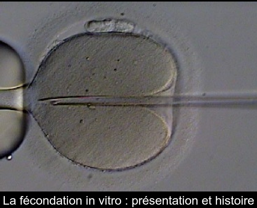 La fécondation in vitro : présentation et histoire La fécondation in vitro : présentation et histoire