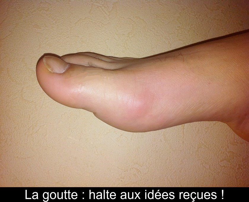 La goutte : halte aux idées reçues !