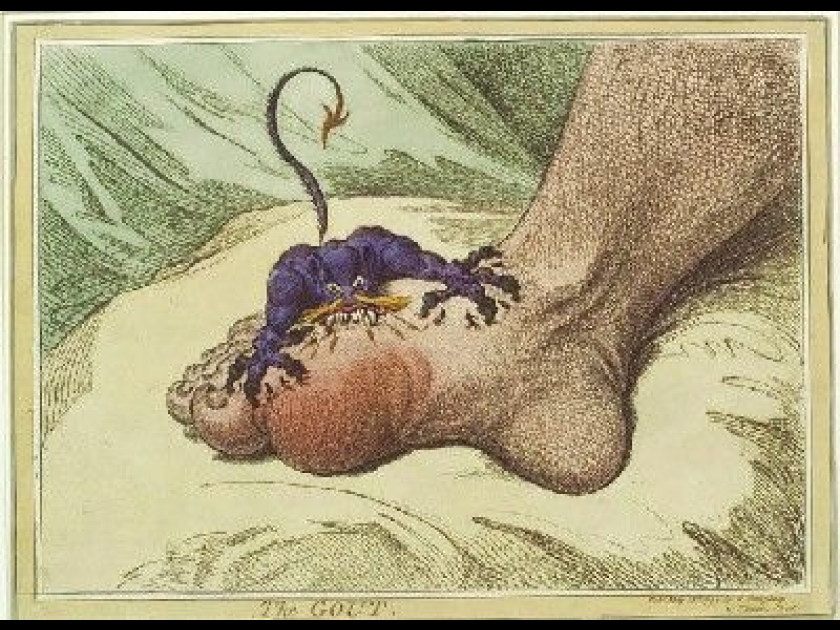 La goutte : symptômes et traitement La goutte : symptômes et traitement