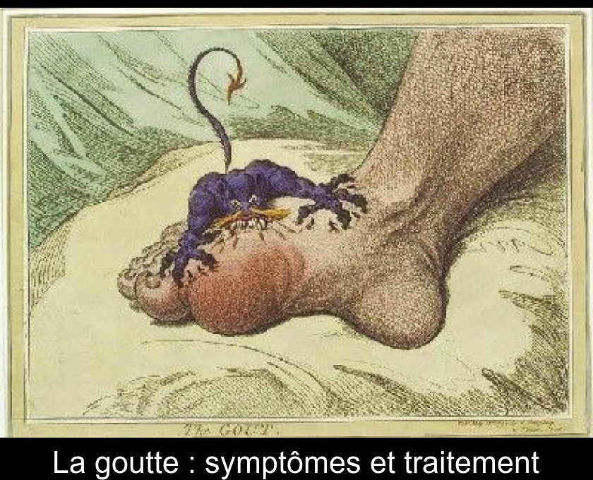 La goutte : symptômes et traitement La goutte : symptômes et traitement