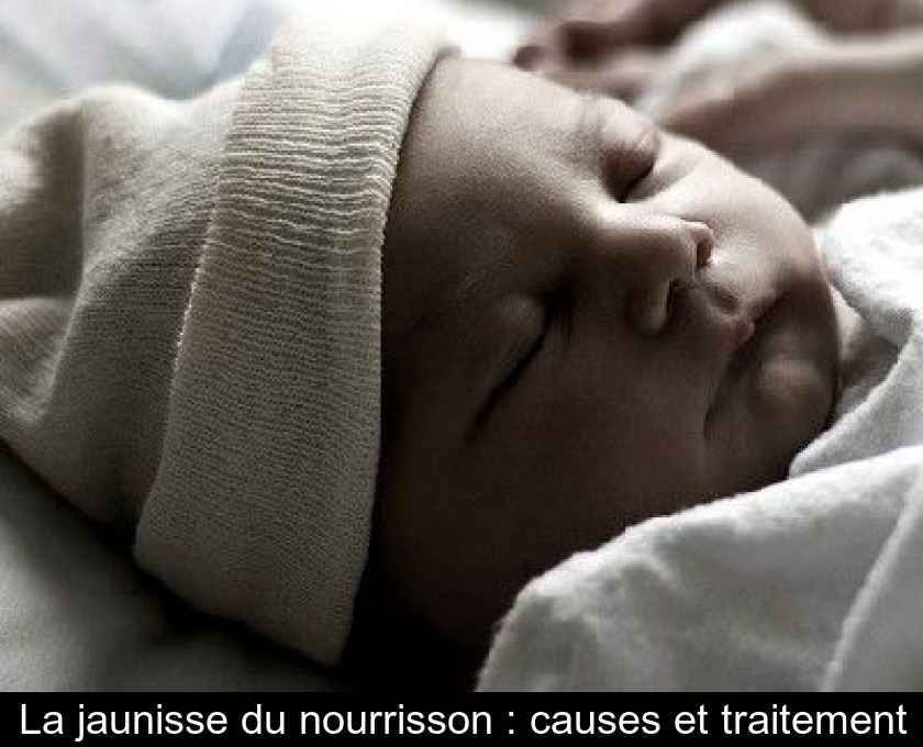 La jaunisse du nourrisson : causes et traitement La jaunisse du nourrisson : causes et traitement