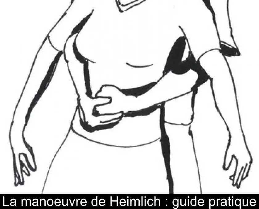 La manoeuvre de Heimlich : guide pratique