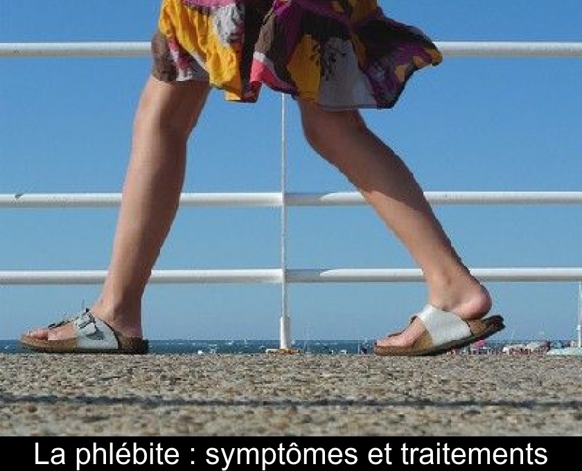 La phlébite : symptômes et traitements La phlébite : symptômes et traitements