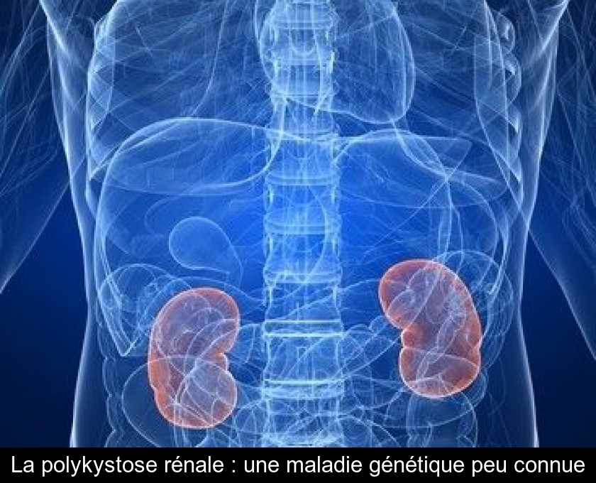 La polykystose rénale : une maladie génétique peu connue La polykystose rénale : une maladie génétique peu connue