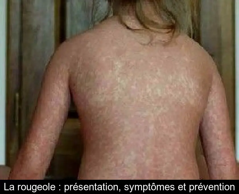 https://www.gralon.net/articles/vignettes/thumb-la-rougeole---presentation--symptomes-et-prevention-4411.jpg