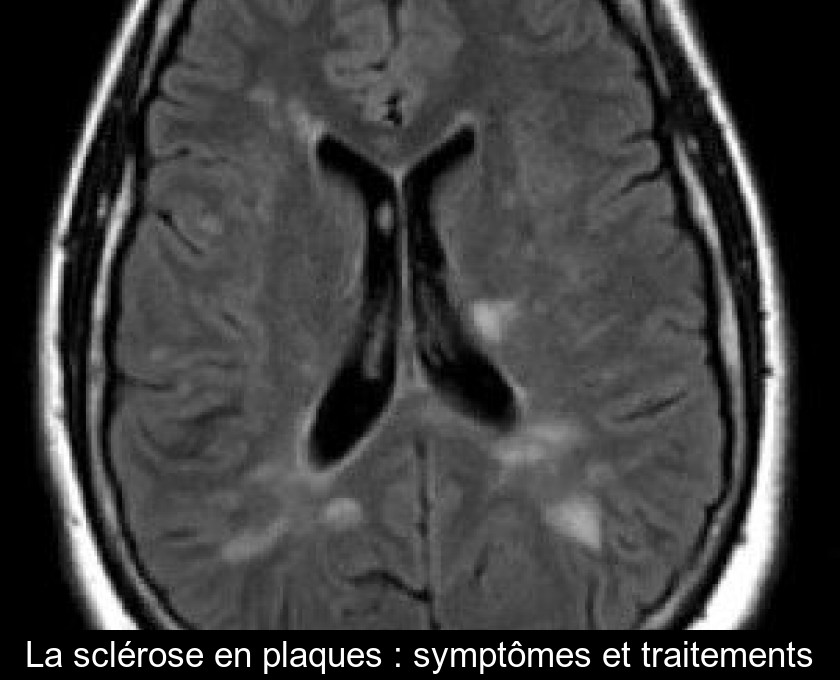 La sclérose en plaques : symptômes et traitements La sclérose en plaques : symptômes et traitements