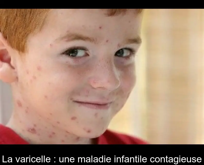 La varicelle : une maladie infantile contagieuse