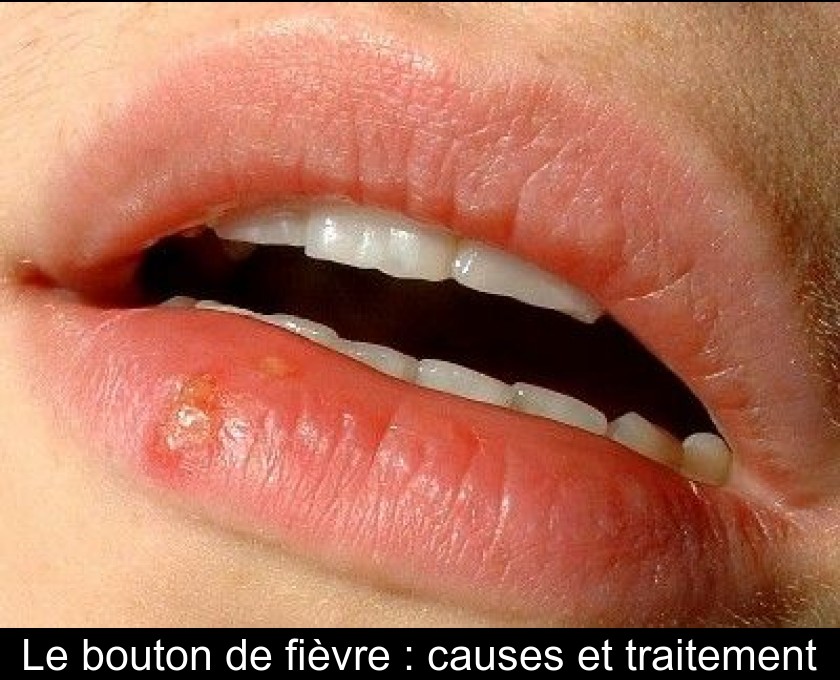 Le bouton de fièvre : causes et traitement Le bouton de fièvre : causes et traitement