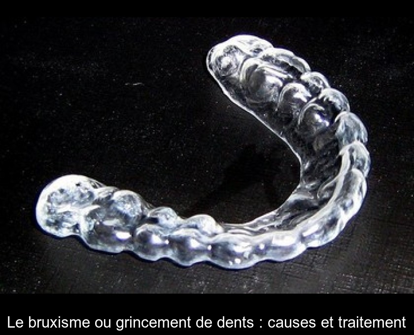 Le bruxisme ou grincement de dents : causes et traitement