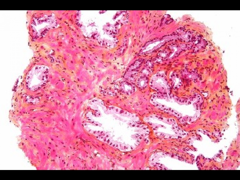 Le cancer de la prostate : diagnostic et traitements Le cancer de la prostate : diagnostic et traitements