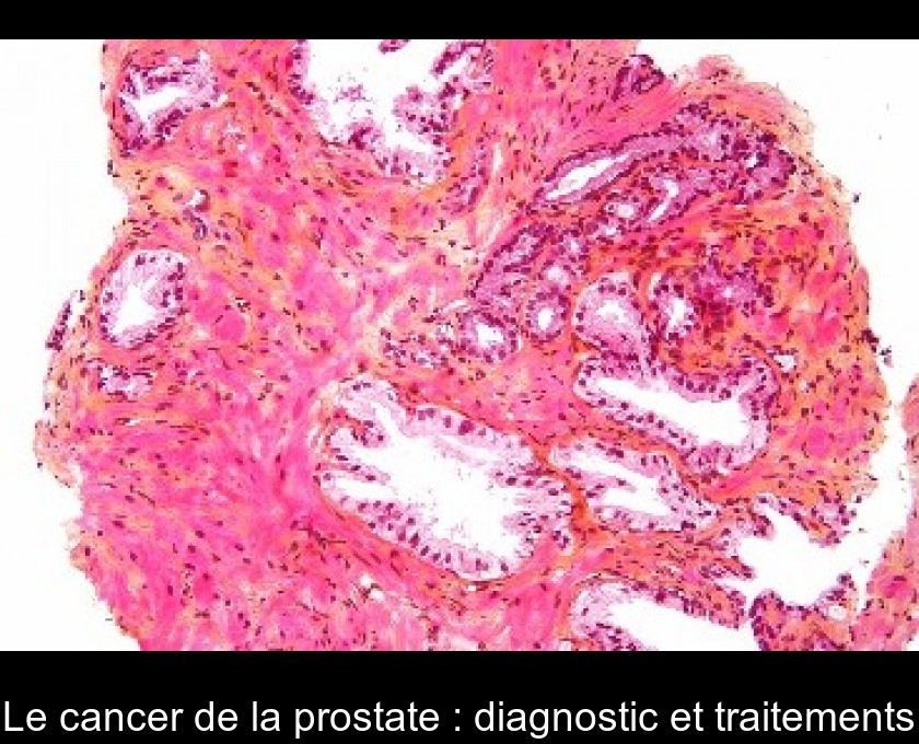 Le cancer de la prostate : diagnostic et traitements Le cancer de la prostate : diagnostic et traitements