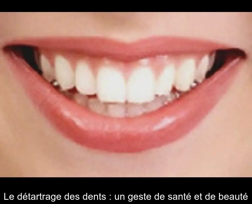 Le détartrage des dents : un geste de santé et de beauté