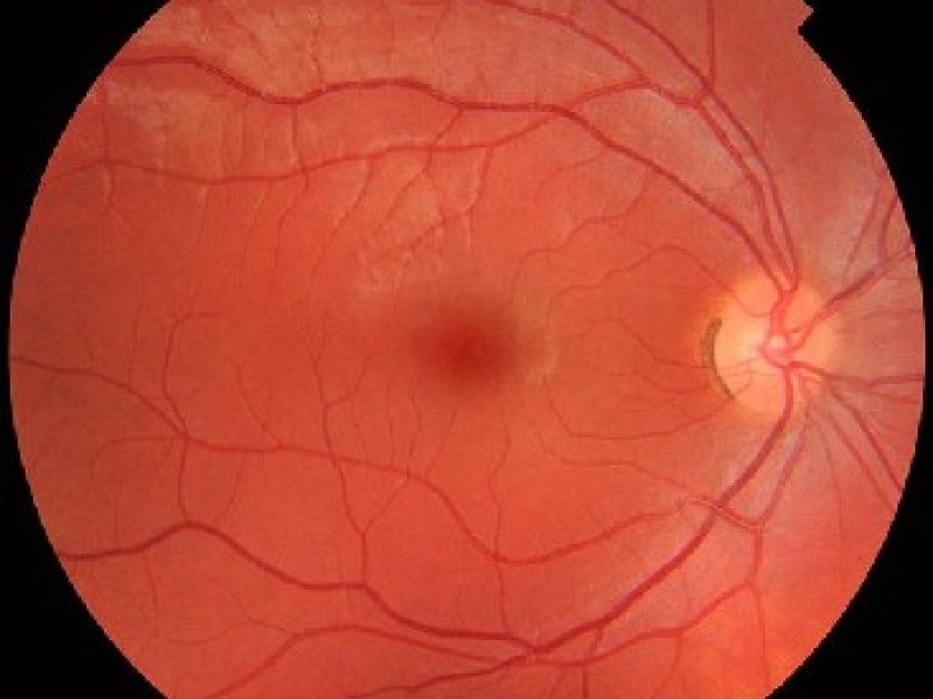 Le fond d'oeil présentation et déroulement