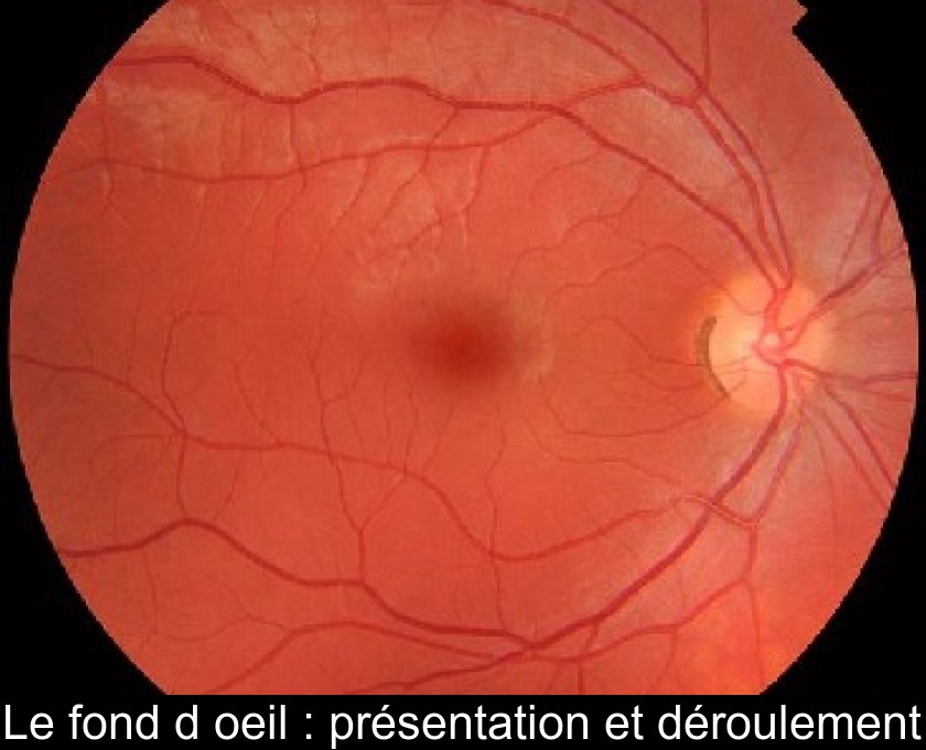 Le fond d'oeil : présentation et déroulement