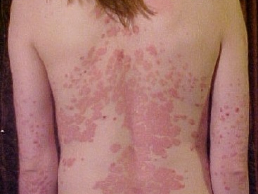 Le psoriasis : halte aux idées reçues Le psoriasis : halte aux idées reçues
