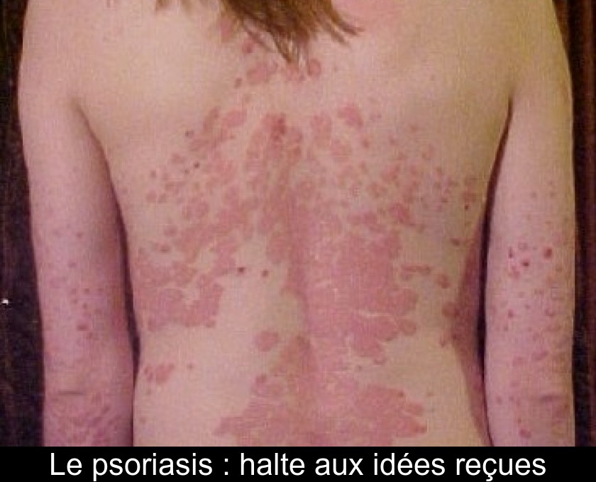 Le psoriasis : halte aux idées reçues