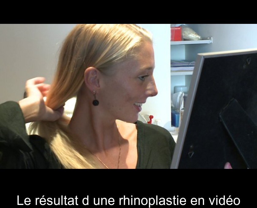 Le résultat d'une rhinoplastie en vidéo Le résultat d'une rhinoplastie en vidéo